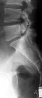 Lateral radiograph of the lumbar spine shows spond