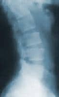 Radiograph of the lumbar spine. This image demonst