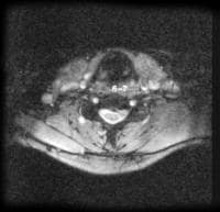 Axial magnetic resonance image of the cervical spi