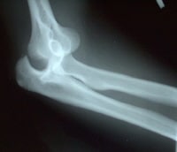 Posterior and lateral dislocation of the left elbo