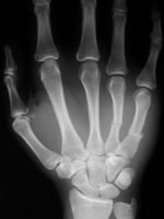 Displaced fourth and fifth metacarpal fractures, a