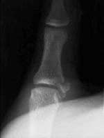 Anteroposterior radiograph displaying a gamekeeper