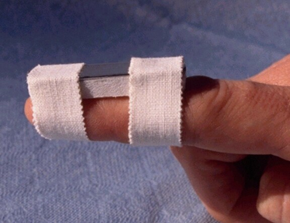of a mallet finger.