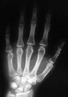 Metacarpophalangeal joint dislocation of the small