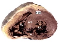 Photograph of heart sectioned transversely at leve