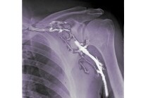 A venogram in a patient with subclavian vein obstr