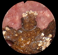 Endoscopic view of spiculated "jack" stone with er