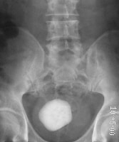 Large calculus visible on plain film of intravenou