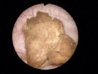 Bladder stone accretion on matrix. Patient had his