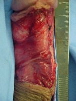Urethral strictures. The anastomosis of the pedicl