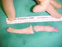 Urethral strictures. A buccal mouth graft has been