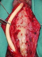 Urethral strictures. The buccal mucosal grafts hav