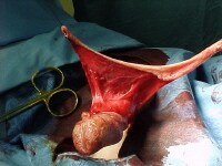 Urethral strictures. Photograph of open urethropla