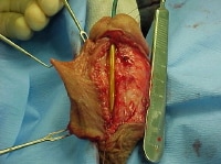 Urethral strictures. Photograph depicting pedicled