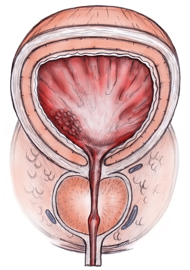 Benign prostatic hyperplasia. The prostate is loc.