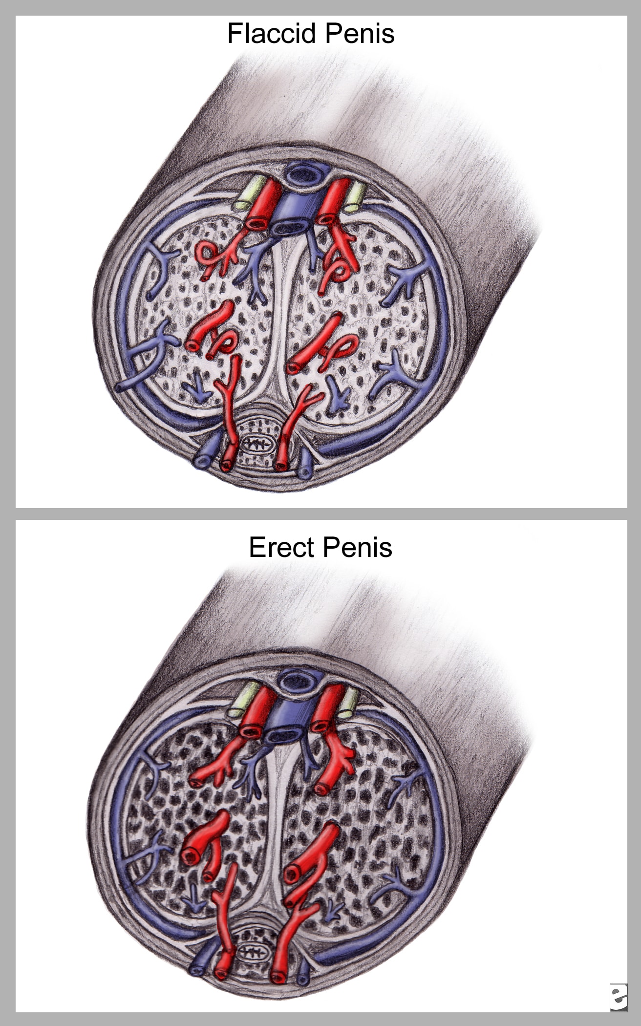 Venous Leakage Cured By Viagra