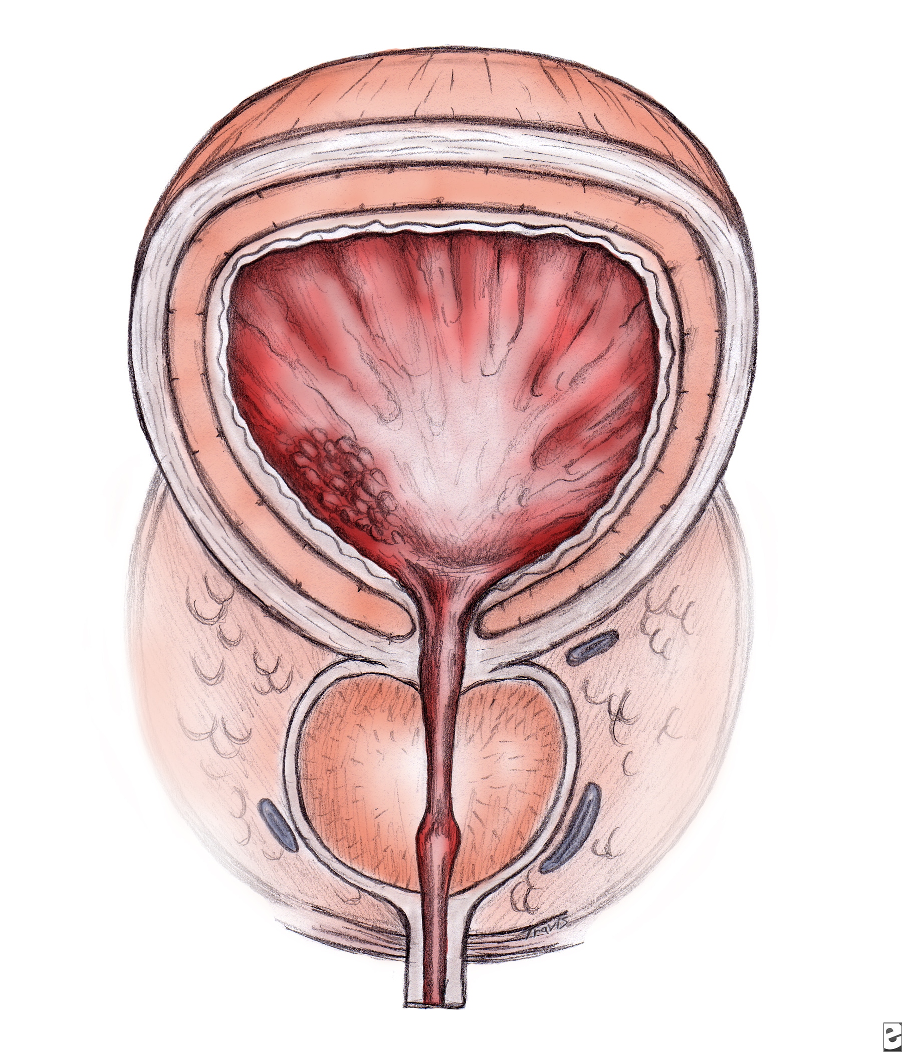 Prostatic Hyperplasia