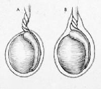 Torção Testicular: (A) extravaginal (B) intrava ...