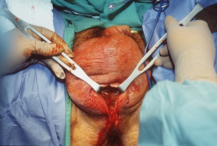 The testicles were not involved. Courtesy of Thomas A. Santora, MD.