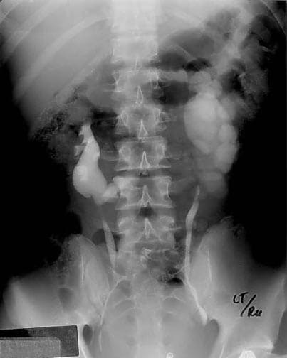 Excretory urogram shows a horseshoe kidney with l.