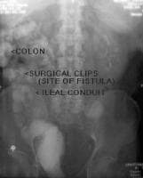 fistula urinary bladder