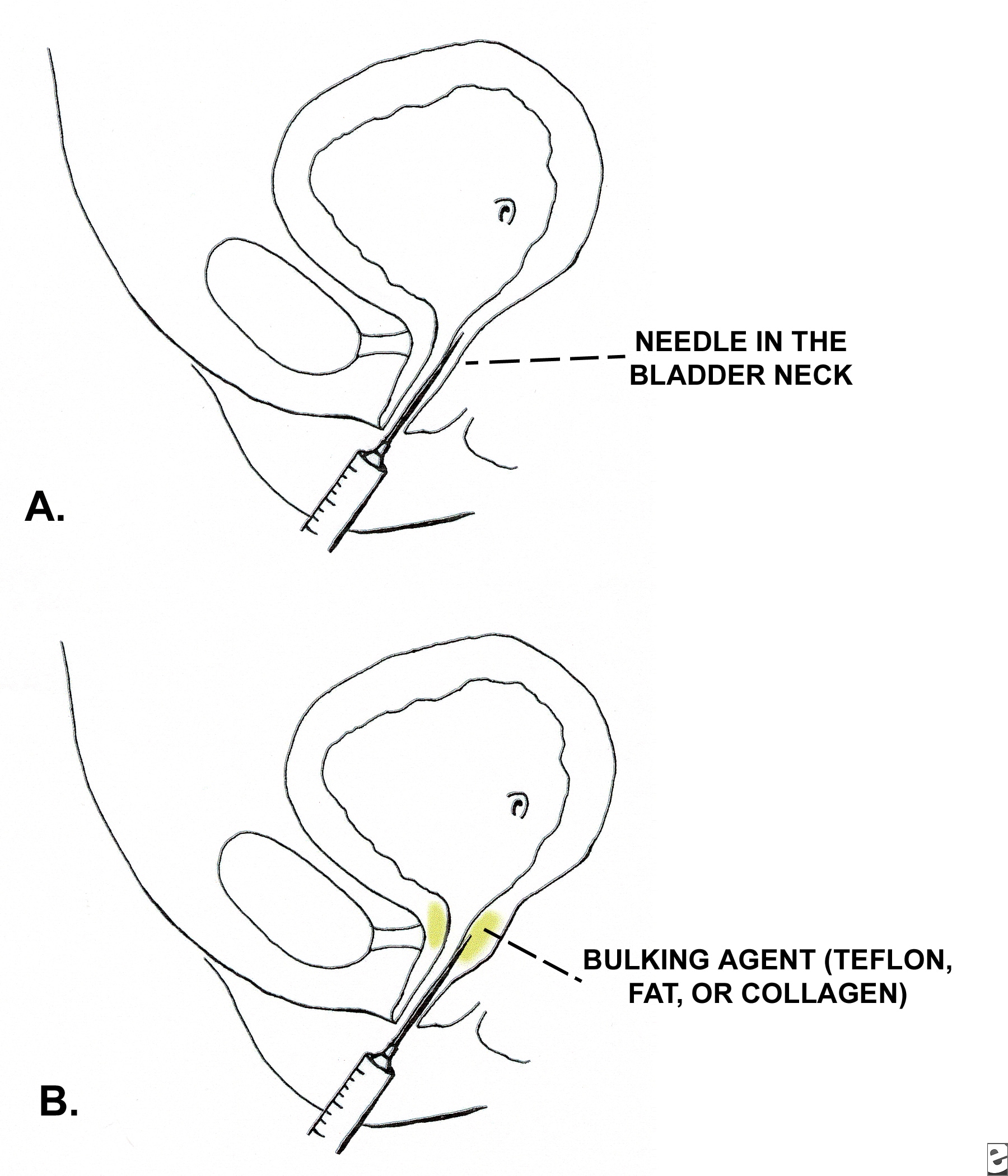 bulking agents > materiali/sostanze di riempimento // bulking agent