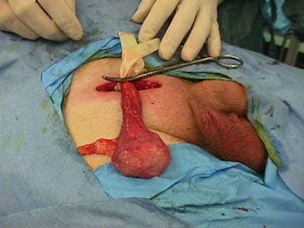 Medscape has a picture of the orchiectomy showing how the testicle is
