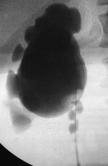 what contrast is used for retrograde pyelogram