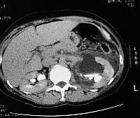 CT scan with intravenous contrast demonstrating po