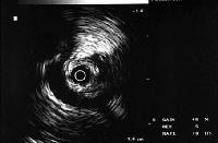 Intraluminal sonogram demonstrating the renal vein