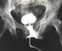 Urethrogram demonstrating partial urethral disrupt
