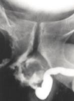 Urethrogram demonstrating complete urethral disrup