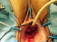 Ureteral Catheter