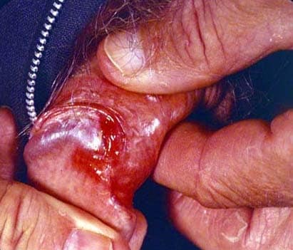 Nodular Basal Cell Carcinoma. NODULAR BASAL CELL CARCINOMA