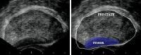 Transrectal sonogram of the prostate showing a hy...