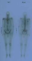 Anterior and posterior bone scans of a patient wi...