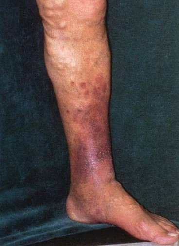 varicose veins eczema