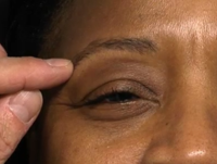 Combination Therapy With Neurotoxins and Fillers