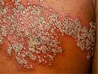 Which Rashes to Worry About: Slideshow