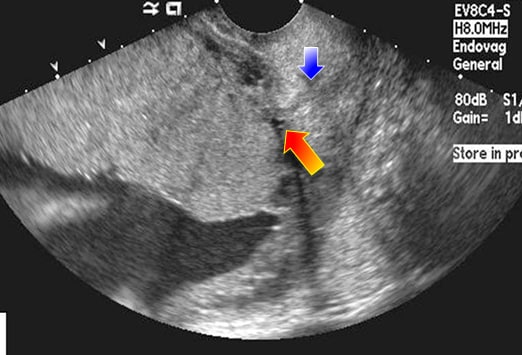 An Alarming Ultrasound in a Pregnant Patient: Case Quiz