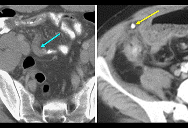 Appendix Gangrene