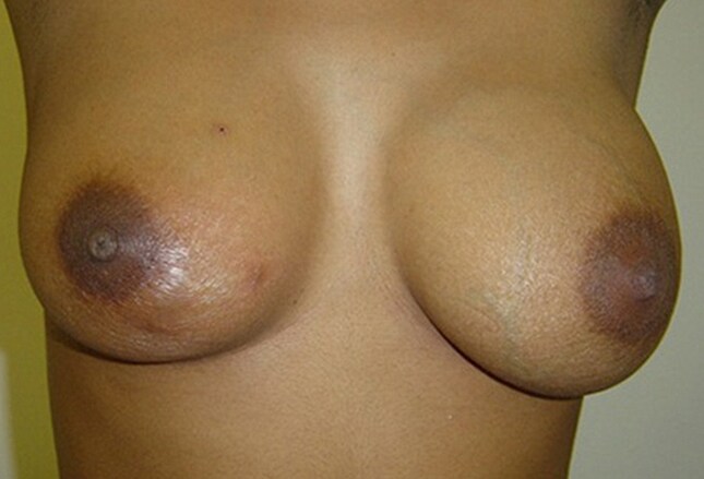 Breast Lump Pictures