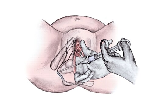 Pelvis Platypelloid