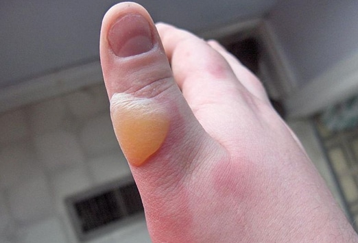 Toe Infection Pus Pictures Photos