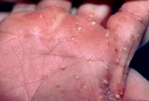 Yeast deals blood infection