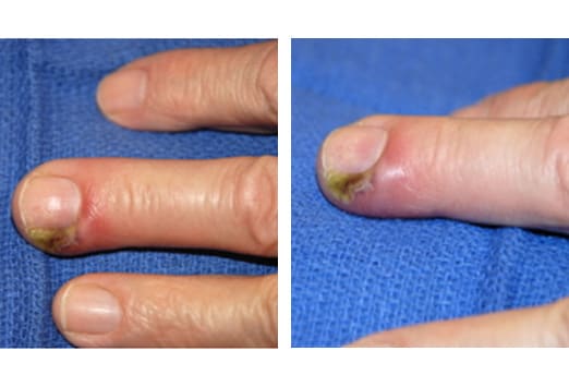 In the image on the right, no pus is found in the nail bed itself