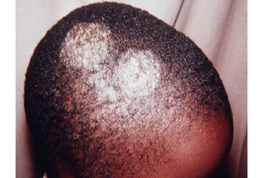 fungus on black skin