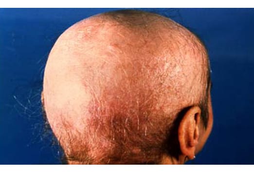 yeast overgrowth on scalp