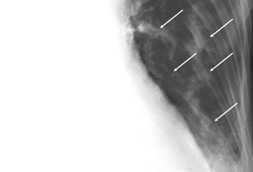 Chest Radiography