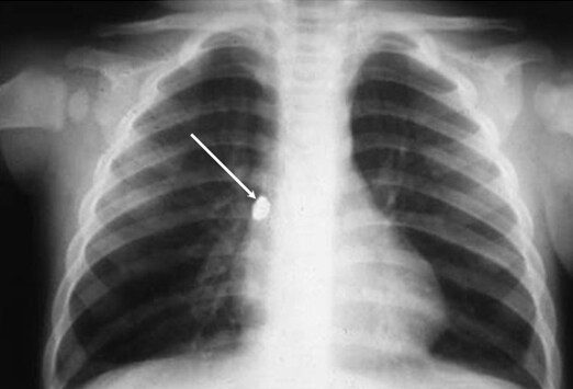 Chest Radiography